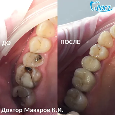 Металлокерамическая коронка Цены, виды. \"Профи-Дент\"