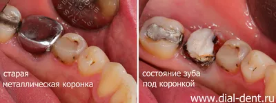 Как ставят коронку на зуб: подробные этапы процедуры установки зубной  коронки в стоматологии