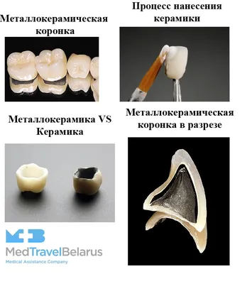 Металлокерамическая коронка недорого Киев