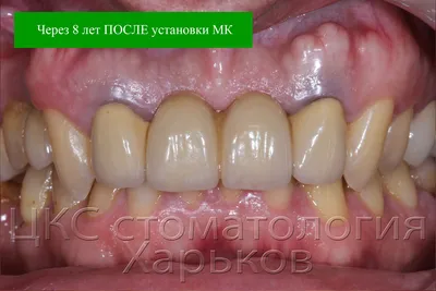 Коронка на зуб - Позняки, Киев. Циркониевые коронки