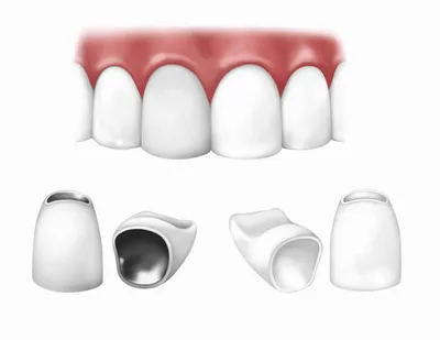 Установка металлокерамических коронок в Томске – низкая цена в стоматологии  «Dentalika»