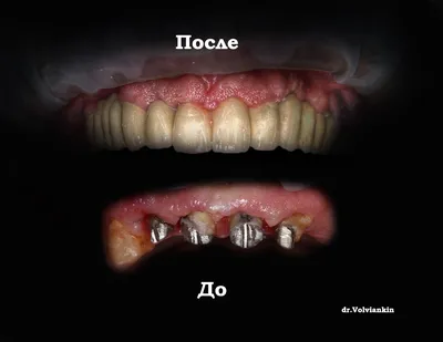 Имплантация переднего зуба с протезированием металлокерамикой — Пример  работы