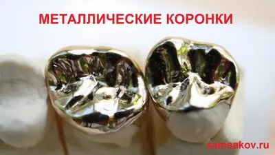 Металлические коронки морально и физически устарели. А что взамен? | Альянс  бьюти-ортопедов, Москва