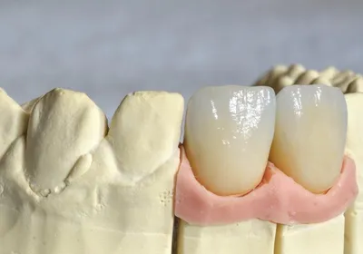 Виды зубных коронок – стоматология Президент