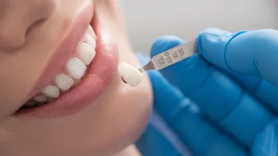 Металлические зубные протезы в СПб