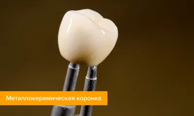 Что такое цельнолитые зубные коронки: их особенности, когда рекомендуют  устанавливать