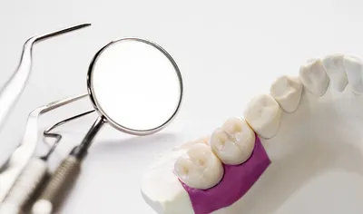 Установка коронки на зуб: этапы проведения процедуры