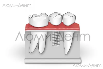 Металлокерамическая коронка Цены, виды. \"Профи-Дент\"
