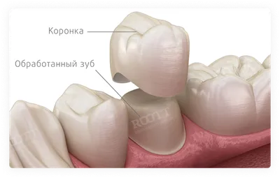 Циркониевые коронки для зубов - преимущества и недостатки: накладки на  основе диоксида (из оксида) циркония в стоматологии, плюсы и минусы, что  это такое, отзывы, фото и цены, чем они хороши, цельноциркониевый материал
