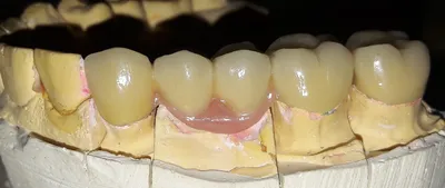Как ставят коронку на зуб: этапы изготовления и установки на зубы — ROOTT