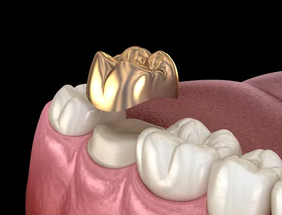 Металлическая коронка - какие бывают, показания