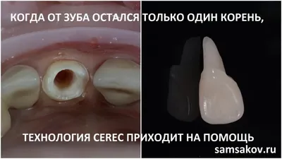 Какие коронки лучше ставить на жевательные зубы: материалы, свойства |  Luxury Smile | Дзен