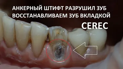 Металлические зубные коронки: насколько они долговечны