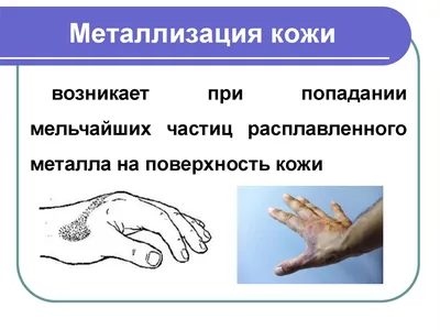 Электротравма - презентация, доклад, проект