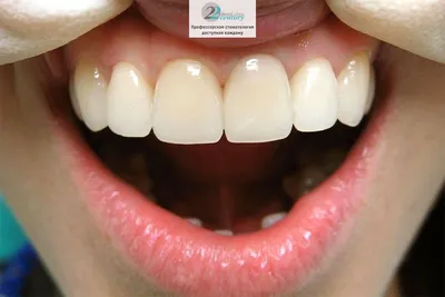 Зубные коронки на верхние зубы в стоматологии \"22 Век\" в Москве