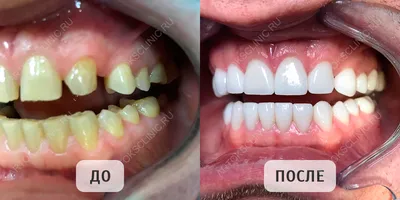 Металлокерамика или цирконий – какие зубные протезы лучше?