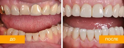 Металлокерамические коронки на зубы — срок службы, отзывы, фото до и после  установки мк коронки