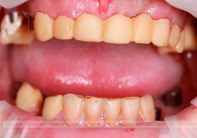 Металлокерамическая коронка на имплант, протезирование зубов — цены в  Москве в стоматологии OneDent.ru