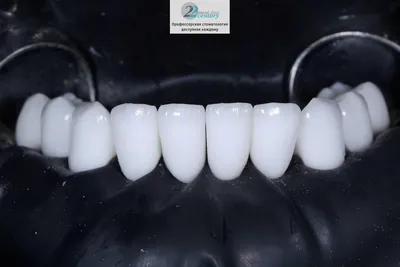 Виниры фото ДО и ПОСЛЕ установки на зубы и лечения