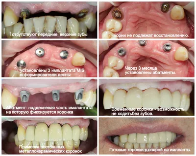 Коронки на передние зубы – металлокерамика, e-max или cerec? | Альянс  бьюти-ортопедов, Москва