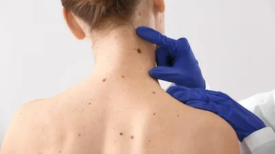 Можно принять за обычный прыщ: Онкологи назвали первый признак рака кожи