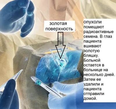 Метастазы глаз при меланоме, раке груди, легких: симптомы. форум на сайте