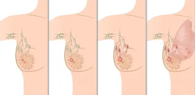 Какие есть стадии рака молочной железы?