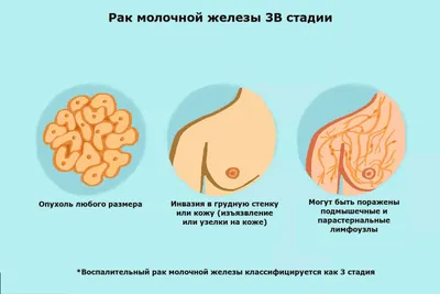 Рак груди 3 стадия, прогноз рака молочной железы 3 степени | Patient-mt.ru