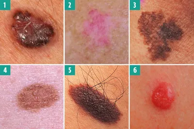 Когда зуд кожи является симптомом рака? | Мед Блог | Дзен