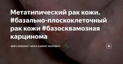 Васильев Ю.С. - Плоскоклеточный рак кожи