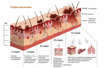Случай №42. Плоскоклеточный рак… и, да, снова про опухоль кожи. | Сайт  дерматовенеролога Бетехтина М.С.