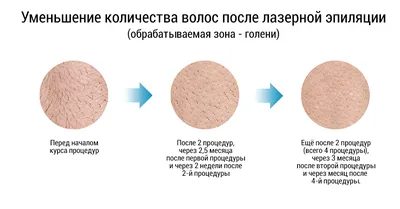 Плакат для косметолога \"Зоны для эпиляции вид сзади\" купить