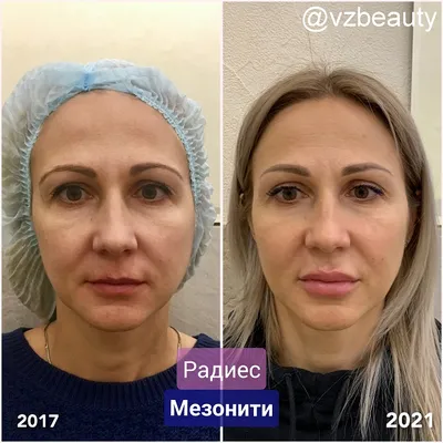 Радиес и Мезонити. Как изменилось лицо за 3 года — vzbeauty.ru