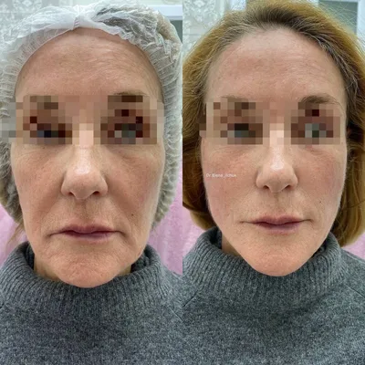 Нитевой лифтинг - подтяжка лица 3D мезонитями в клинике Медицина для Вас на  Красносельской