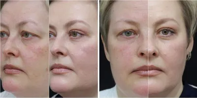 Фракционное лазерное омоложение кожи лица - цены, фото до и после