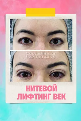 Мезонити в Новосибирске | Подтяжка лица мезонитями - цена, фото до и после  в косметологии Би Лучче