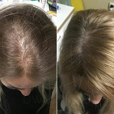 Мезотерапия для волос фото до и после фото