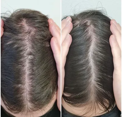Мезотерапия для волос - остановить выпадение волос