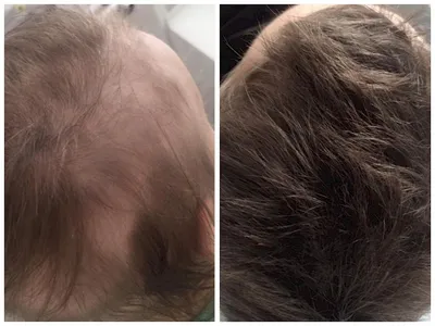 Мезотерапия: лечение выпадения волос у мужчин