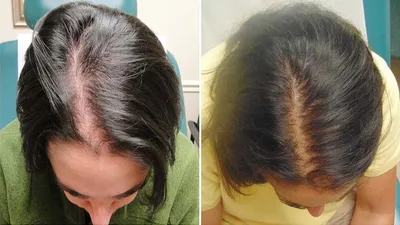 Наталия Евгеньевна Обрусник - Мезотерапия волос💉 Результат после 4-х  процедур😇 Мезотерапия головы-это инъекции в кожу головы направлены на  восстановление волос. Что именно может сделать эта процедура:  ✓Остановить/уменьшить выпадение ✓Ускорить рост ...