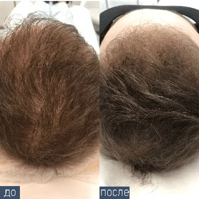Мезотерапия для волос и волосистой части головы в Москве