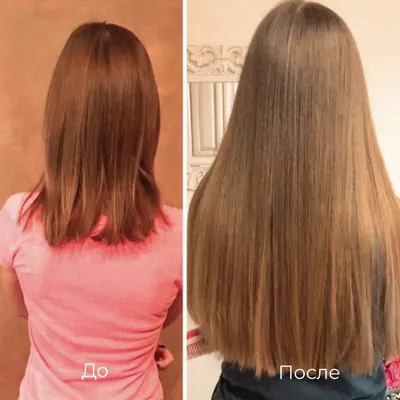 Фото до и после процедуры мезотерапии для волос в клинике Селин