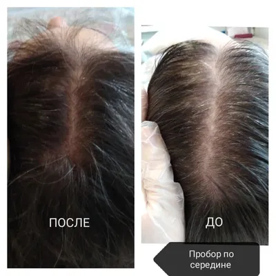 Мезотерапия для волос в Перми - цены, отзывы - Клиника косметологии БьютиМед