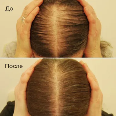 Мезотерапия при выпадении волос - Cosmedica - Dr. Acar