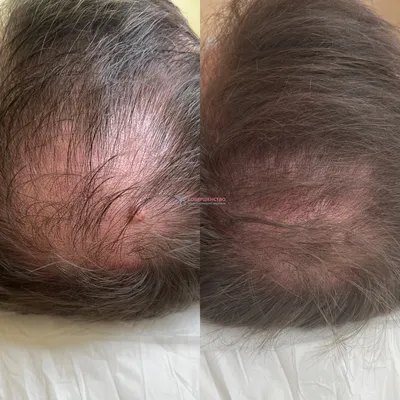 Фото до и после процедуры мезотерапии для волос в клинике Селин
