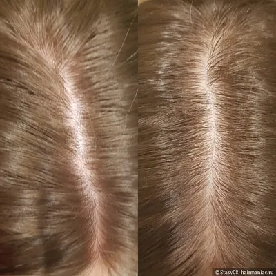 Мезотерапия волос в СПб