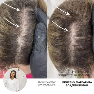 Мезотерапия для волос в Симферополе — Цены на курс процедур — Сделать  мезотерапию кожи головы