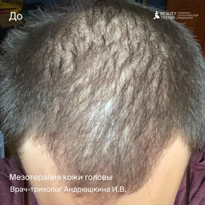 Мезотерапия для волос в Симферополе — Цены на курс процедур — Сделать  мезотерапию кожи головы