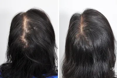 Мезотерапия для волос и волосистой части головы в Москве