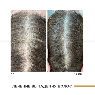 Мезотерапия волос в Москве — Мезотерапия волос Цена